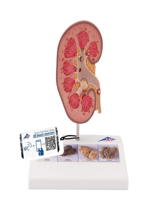 3بي ساينتفك نموذج حصى الكلى K29 من 3B Scientific - 3B Smart Anatomy - Image 1